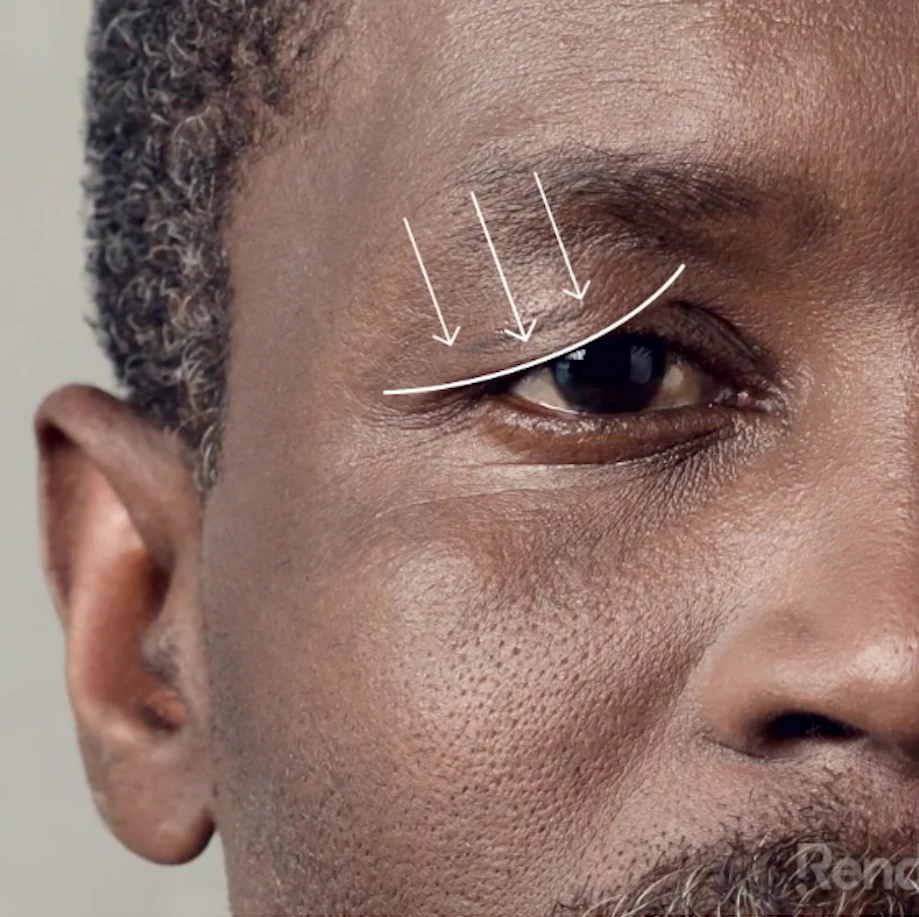 blepharoplasty video cover