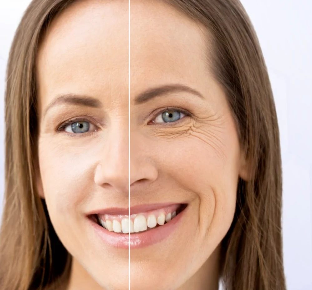 before and after simulation of dermal fillers