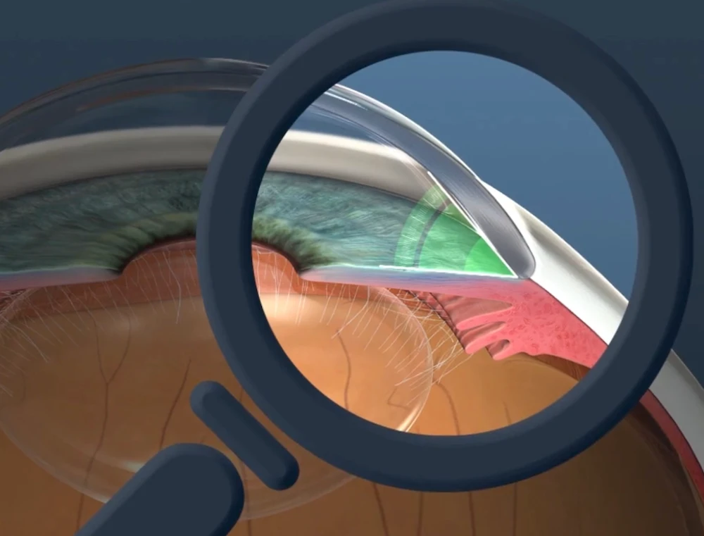 glaucoma video cover